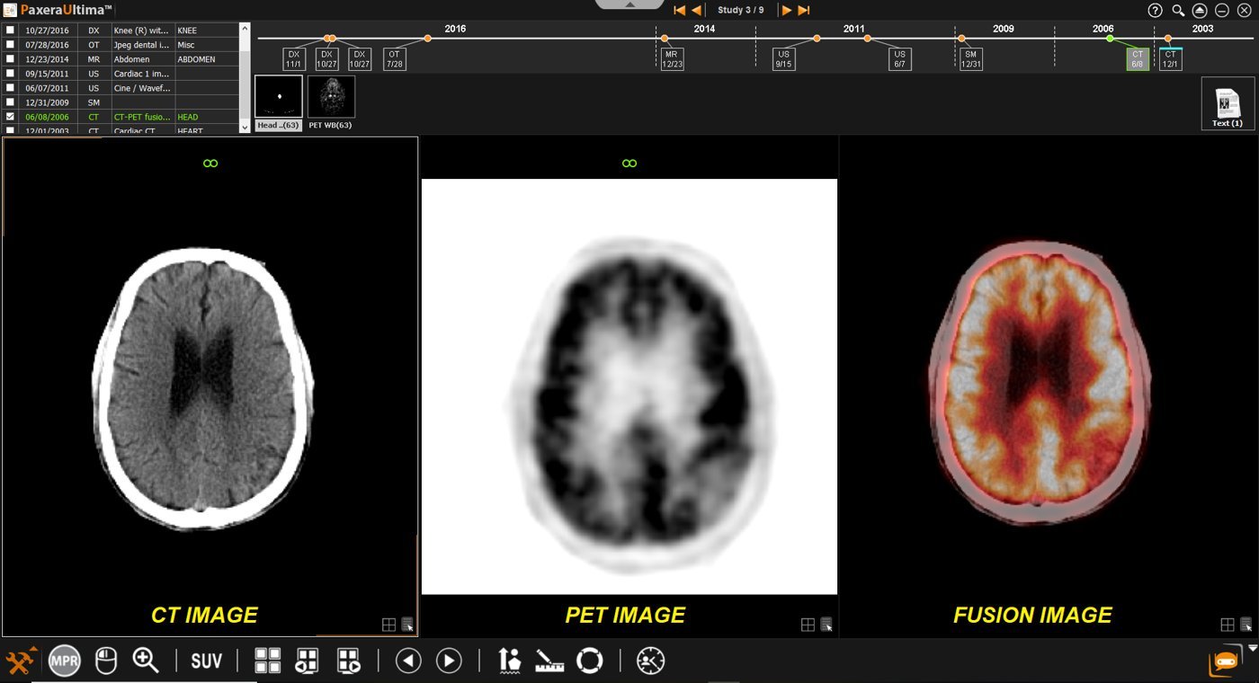 Fusión PET-CT
