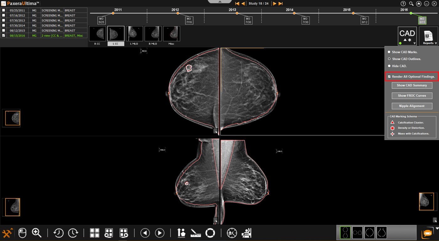 Mamografía con CAD